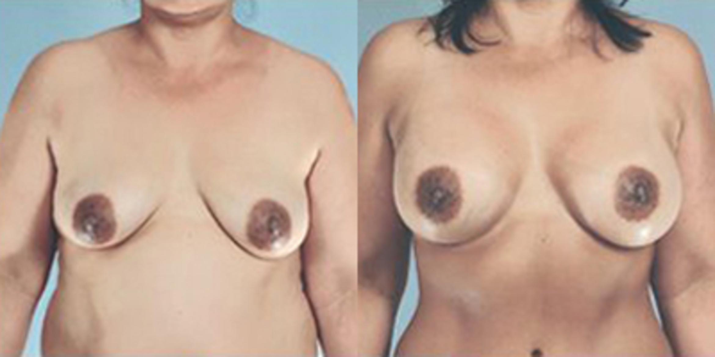 Before & After Breast Augmentation Case 4764 View 1 View in Houston, TX