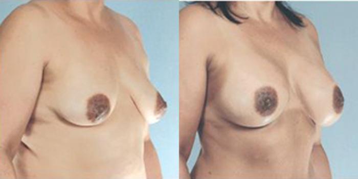 Before & After Breast Augmentation Case 4764 View 2 View in Houston, TX
