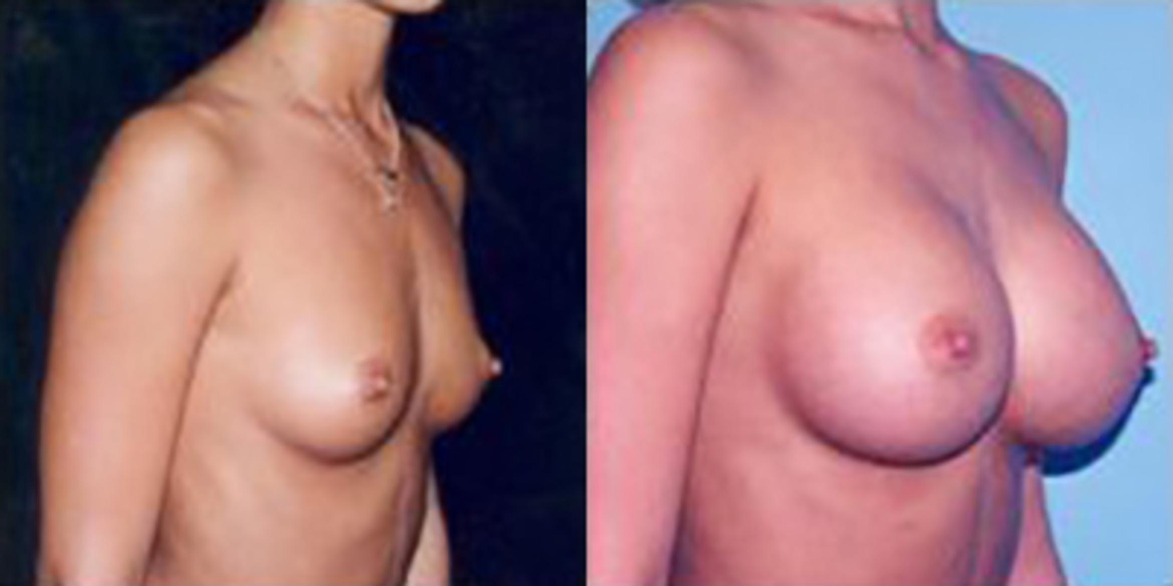 Before & After Breast Augmentation Case 4770 View 1 View in Houston, TX
