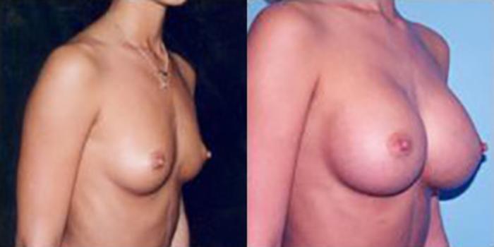Before & After Breast Augmentation Case 4770 View 1 View in Houston, TX