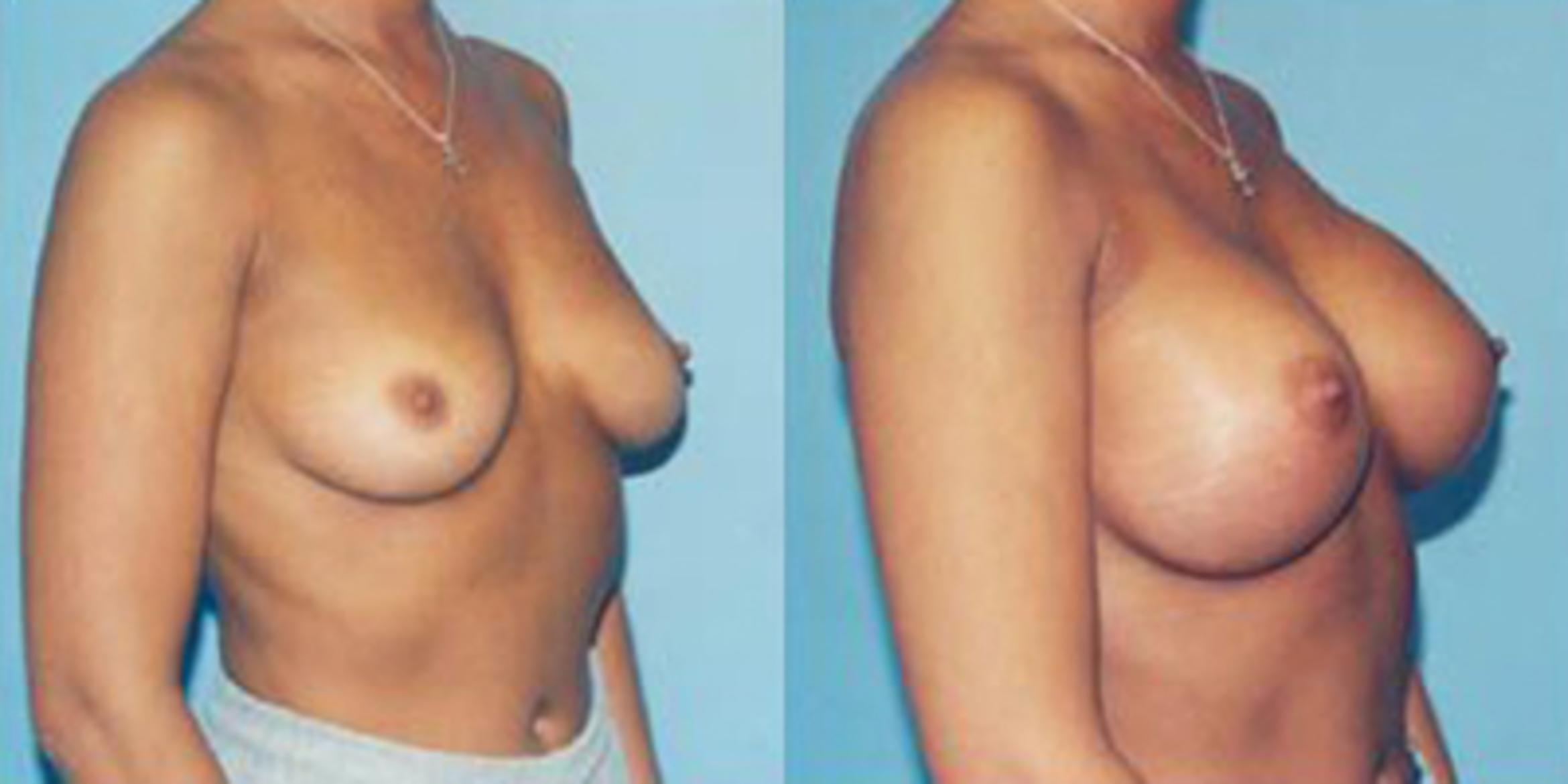 Before & After Breast Augmentation Case 4778 View 1 View in Houston, TX