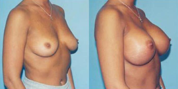 Before & After Breast Augmentation Case 4778 View 1 View in Houston, TX