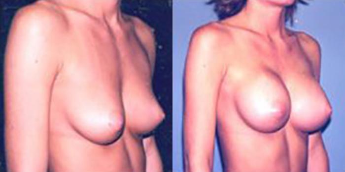 Before & After Breast Augmentation Case 4782 View 1 View in Houston, TX