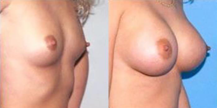 Before & After Breast Augmentation Case 4786 View 1 View in Houston, TX
