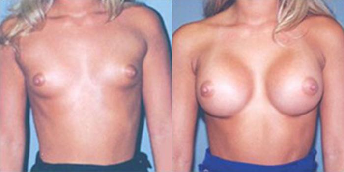 Before & After Breast Augmentation Case 4790 View 1 View in Houston, TX