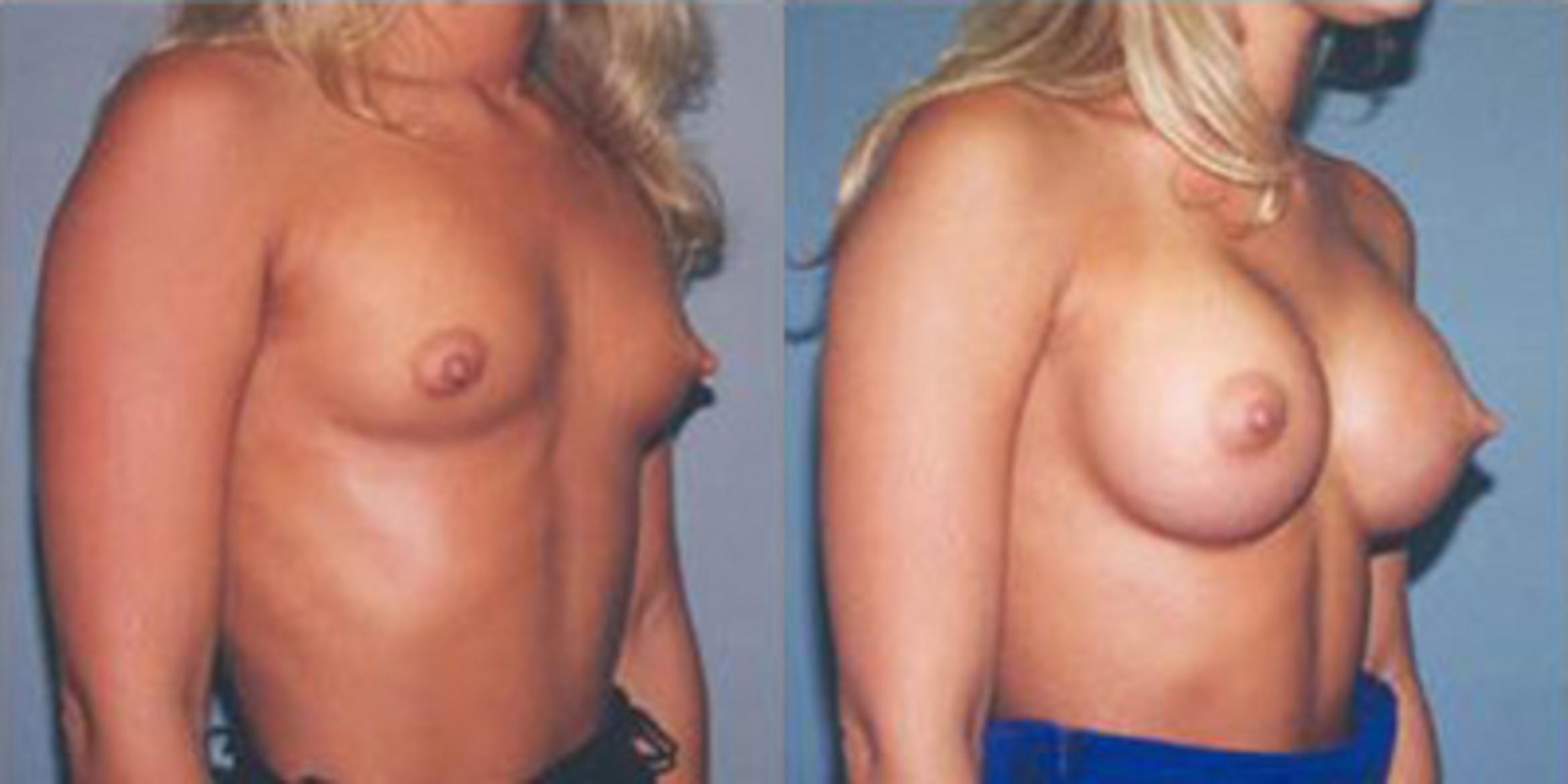 Before & After Breast Augmentation Case 4790 View 2 View in Houston, TX