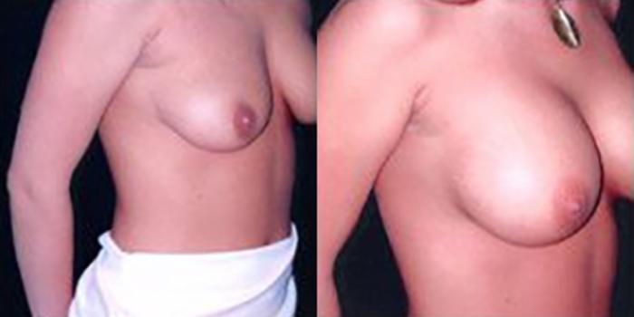 Before & After Breast Augmentation Case 4796 View 1 View in Houston, TX