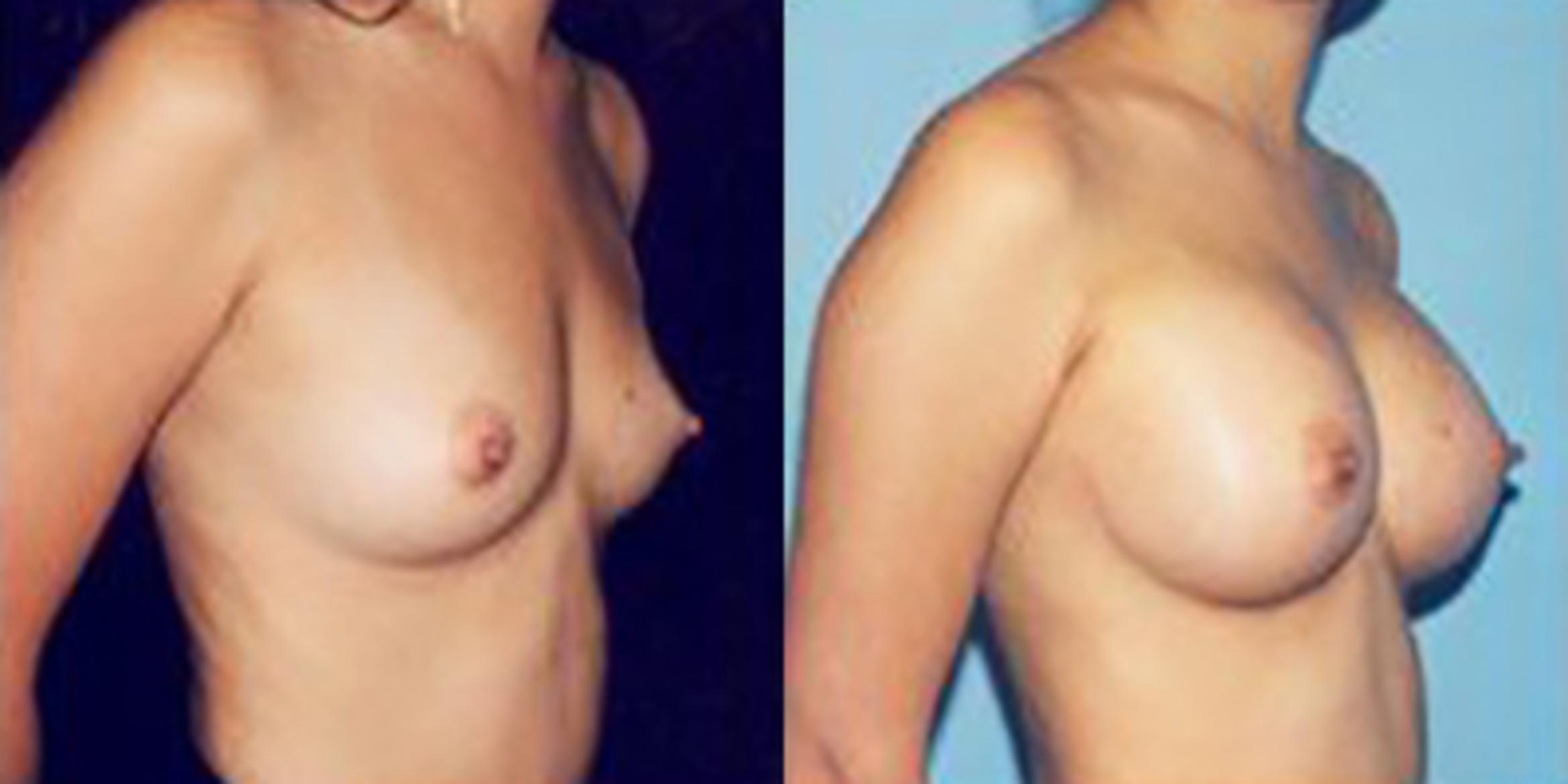 Before & After Breast Augmentation Case 4800 View 1 View in Houston, TX