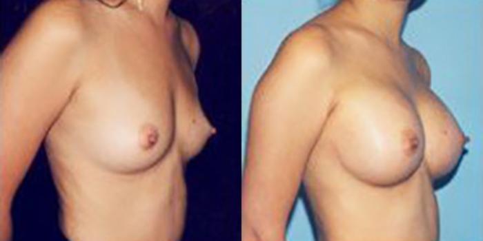 Before & After Breast Augmentation Case 4800 View 1 View in Houston, TX