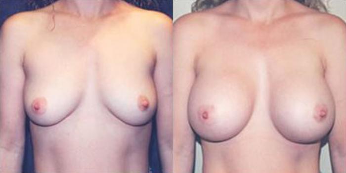 Before & After Breast Augmentation Case 4804 View 1 View in Houston, TX