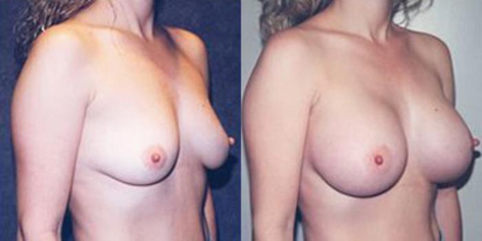 Before & After Breast Augmentation Case 4804 View 2 View in Houston, TX
