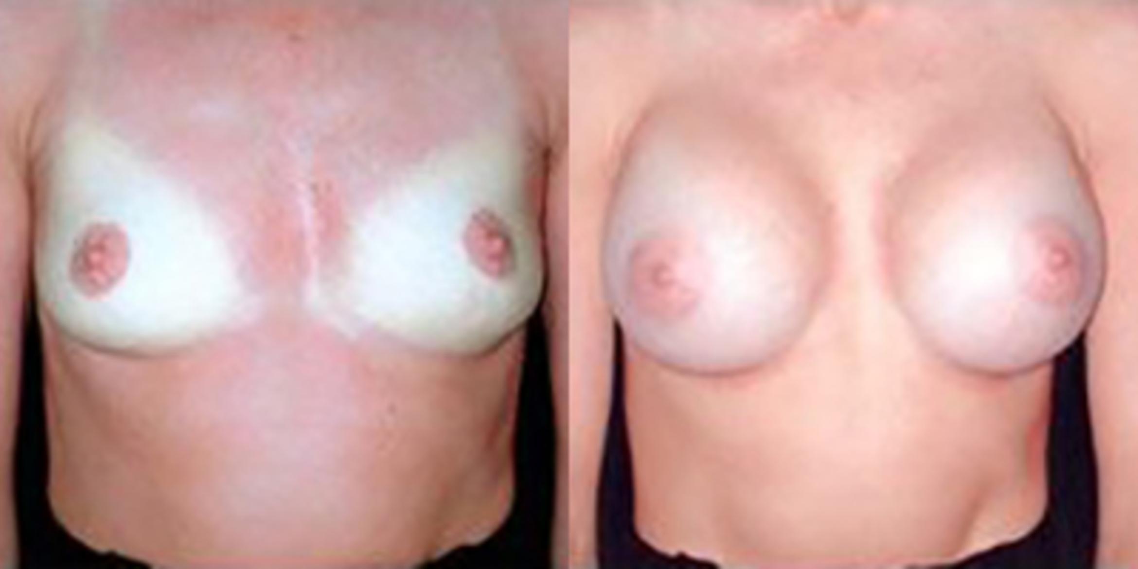 Before & After Breast Augmentation Case 4810 View 1 View in Houston, TX
