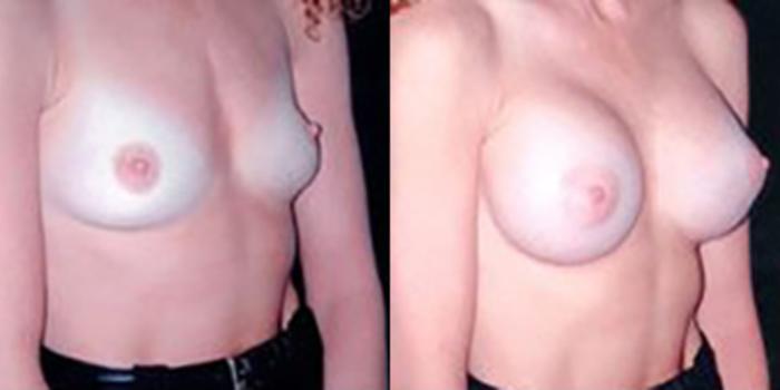 Before & After Breast Augmentation Case 4810 View 2 View in Houston, TX