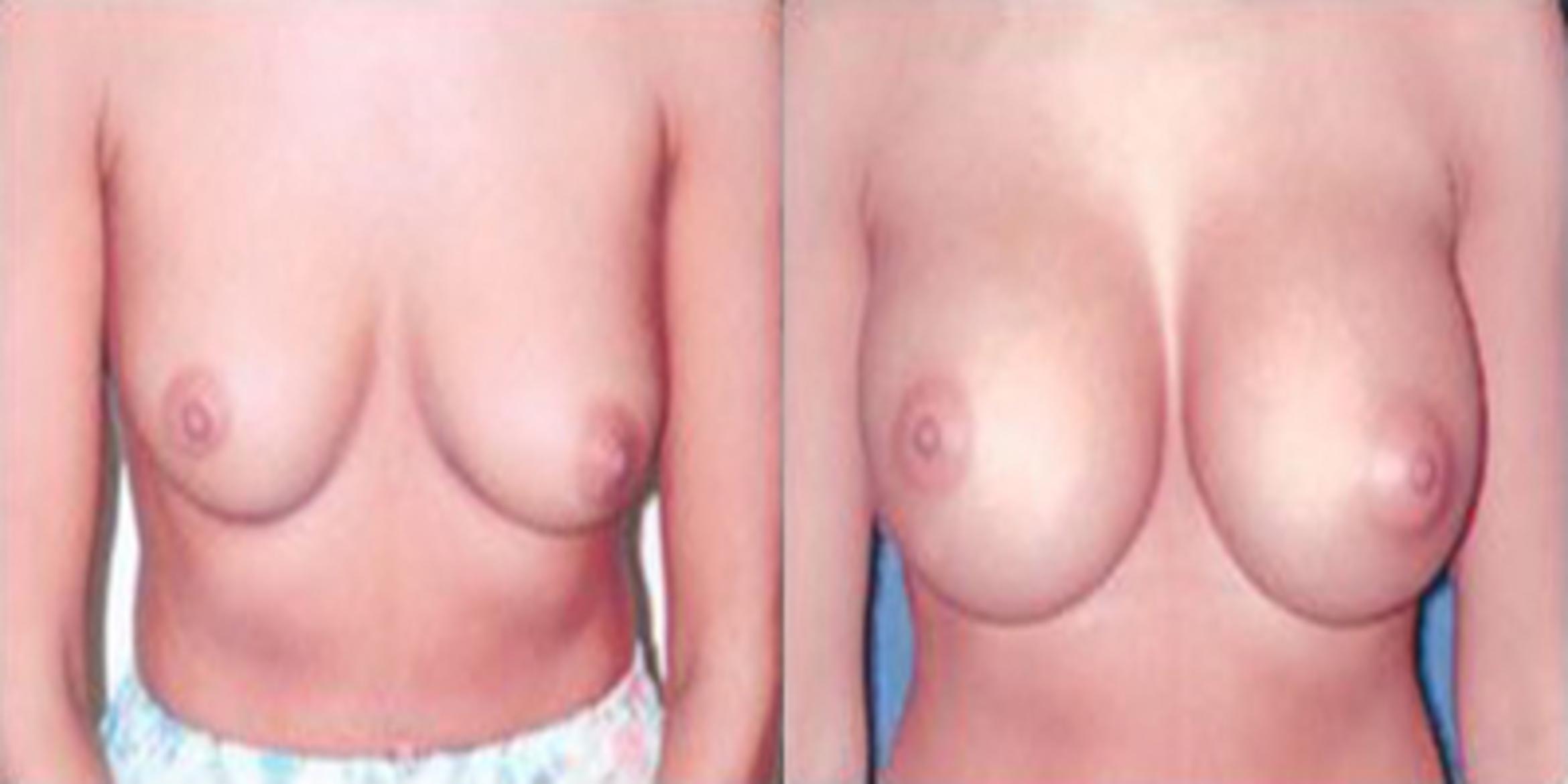 Before & After Breast Augmentation Case 4816 View 1 View in Houston, TX