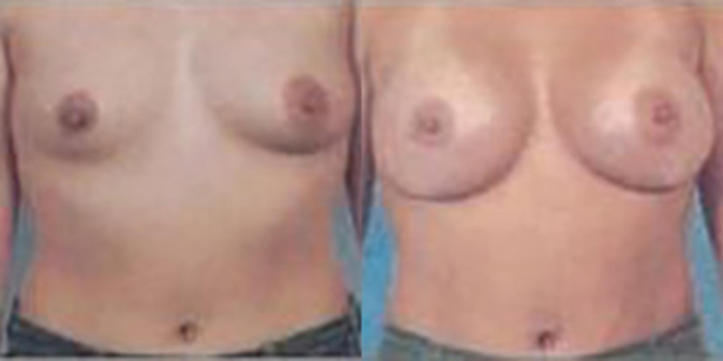 Before & After Breast Augmentation Case 4820 View 1 View in Houston, TX