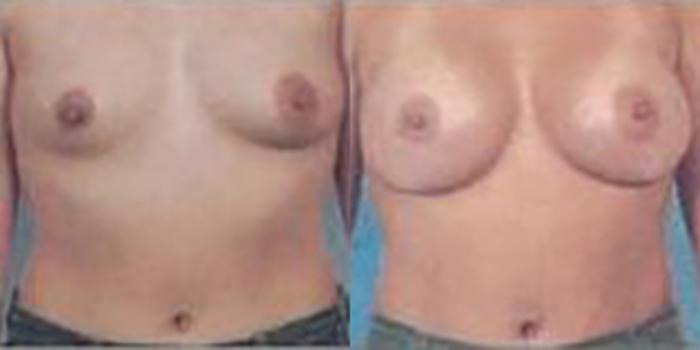 Before & After Breast Augmentation Case 4820 View 1 View in Houston, TX