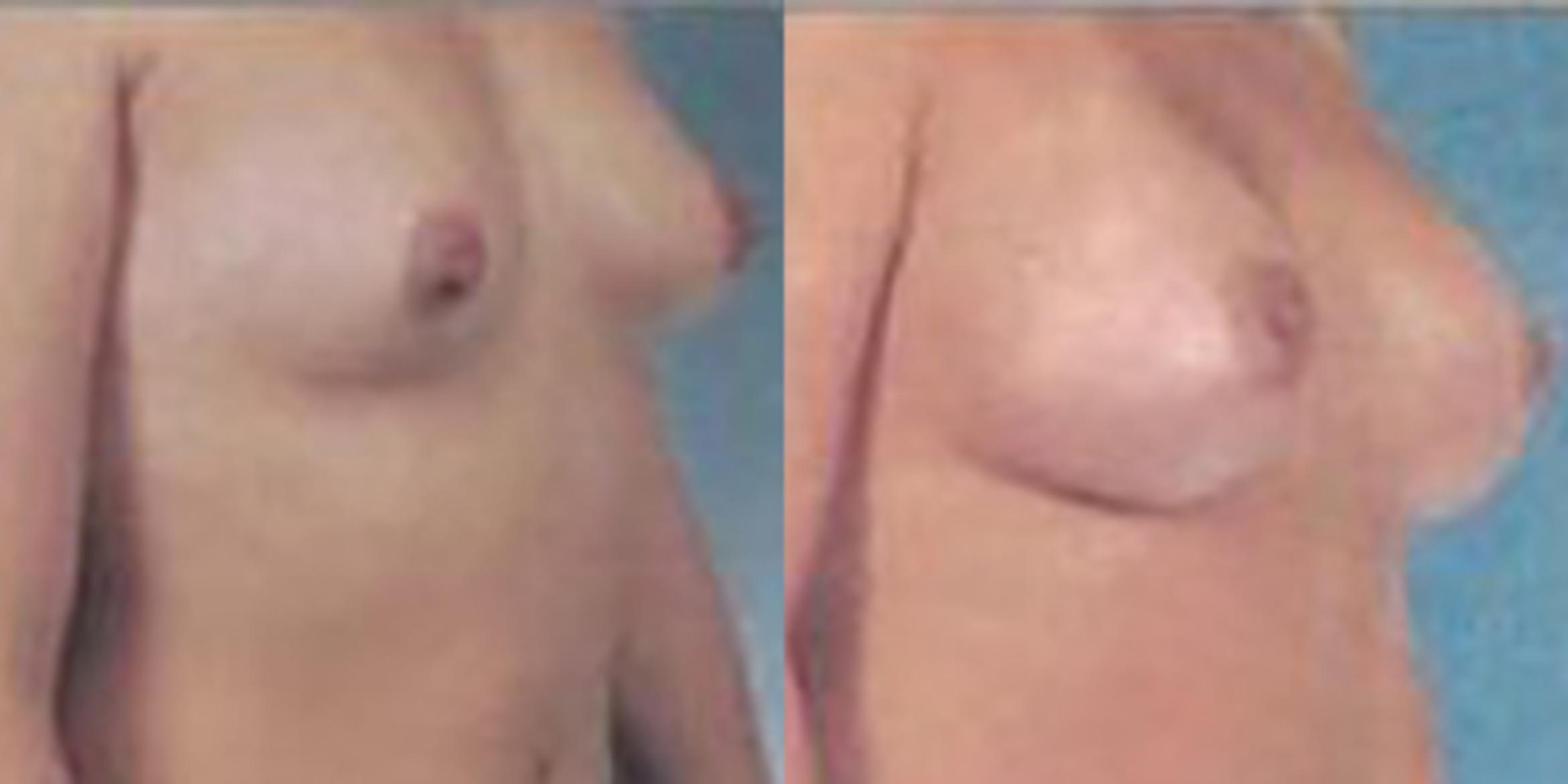 Before & After Breast Augmentation Case 4820 View 2 View in Houston, TX