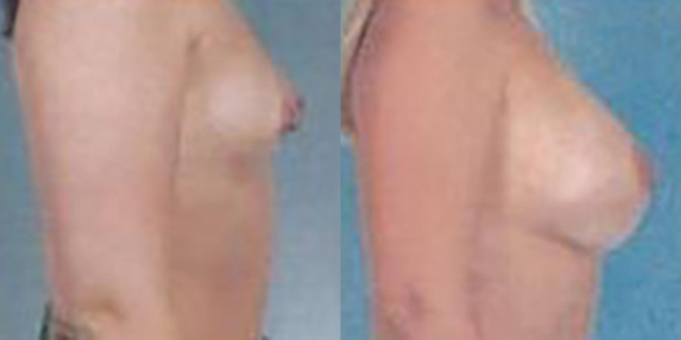 Before & After Breast Augmentation Case 4820 View 3 View in Houston, TX