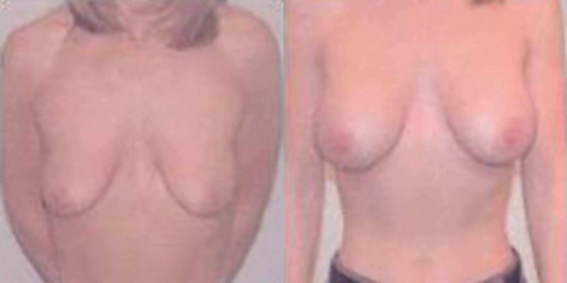 Before & After Breast Augmentation Case 4828 View 1 View in Houston, TX