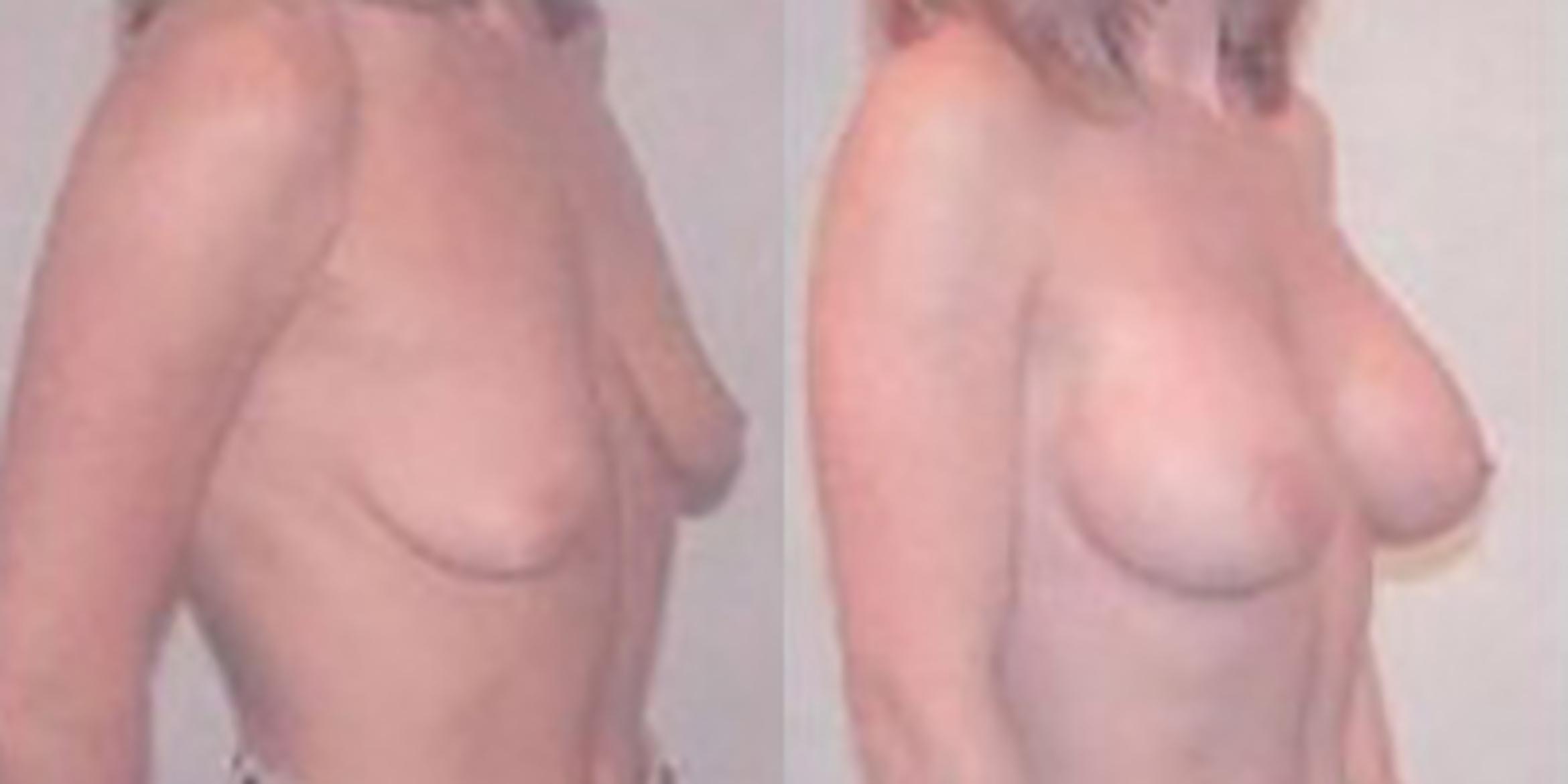 Before & After Breast Augmentation Case 4828 View 2 View in Houston, TX