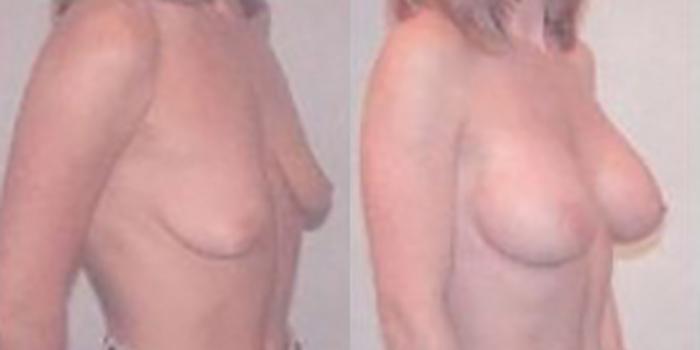 Before & After Breast Augmentation Case 4828 View 2 View in Houston, TX