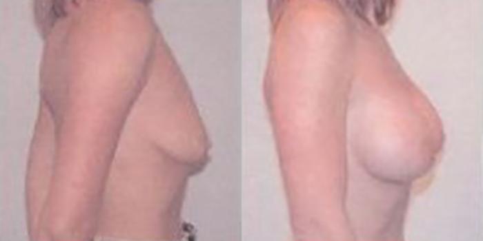 Before & After Breast Augmentation Case 4828 View 3 View in Houston, TX