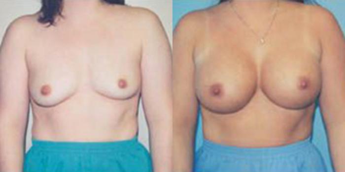Before & After Breast Augmentation Case 4836 View 1 View in Houston, TX