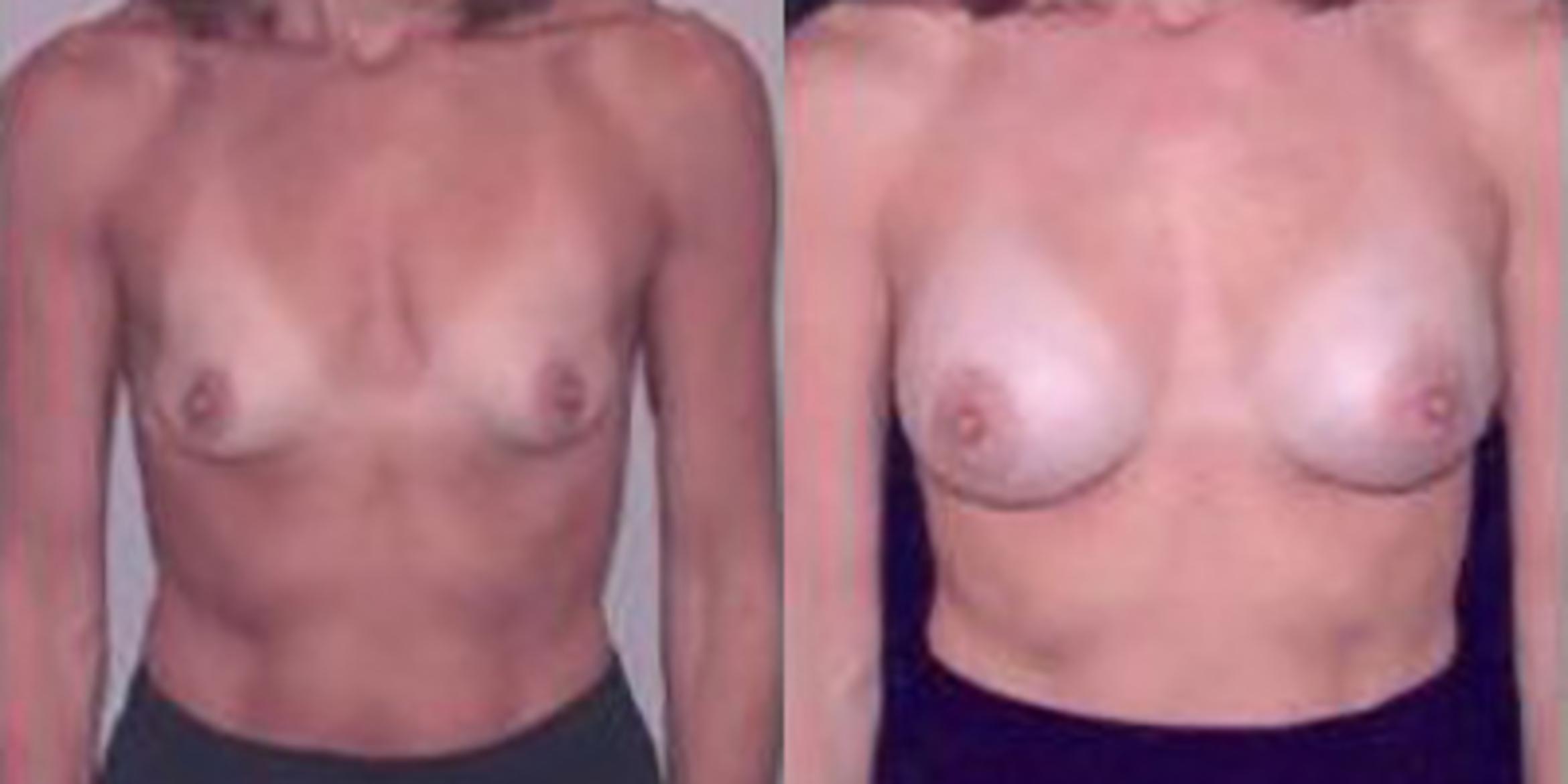 Before & After Breast Augmentation Case 4840 View 1 View in Houston, TX