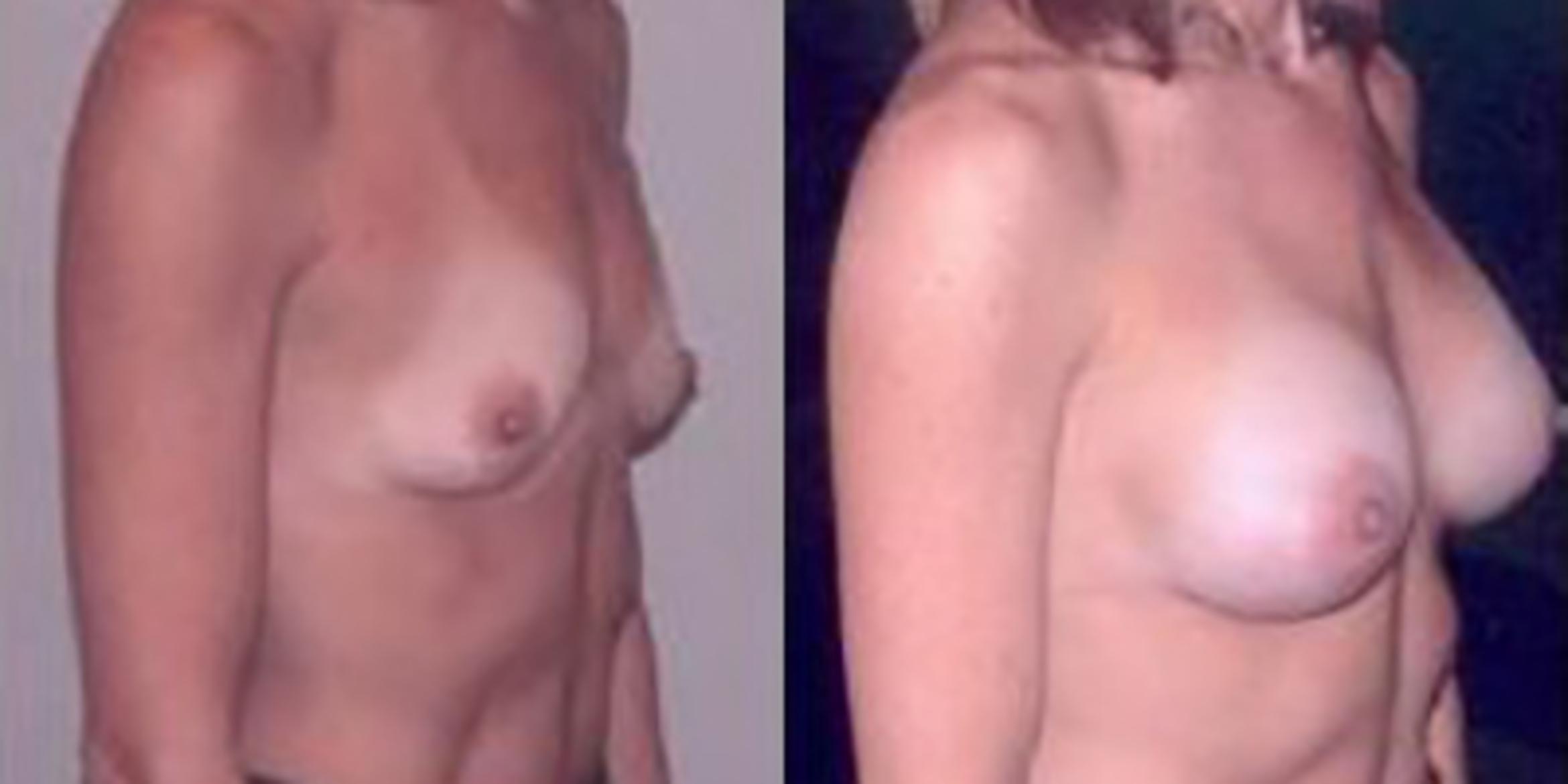 Before & After Breast Augmentation Case 4840 View 2 View in Houston, TX