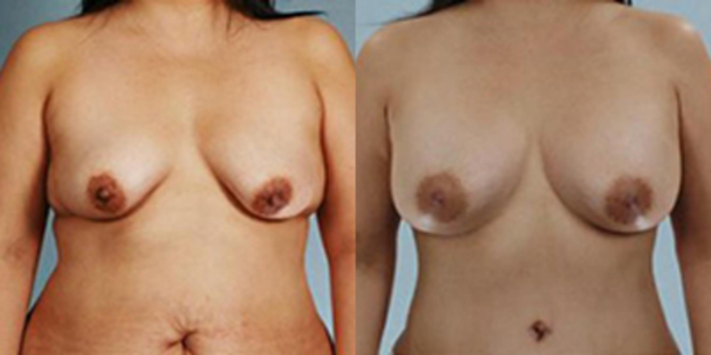 Before & After Breast Augmentation Case 4846 View 1 View in Houston, TX