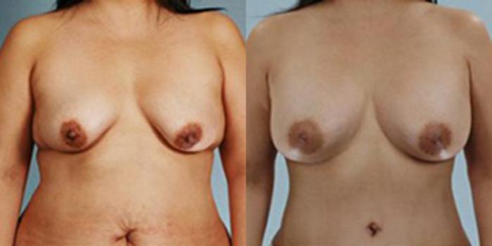 Before & After Breast Augmentation Case 4846 View 1 View in Houston, TX