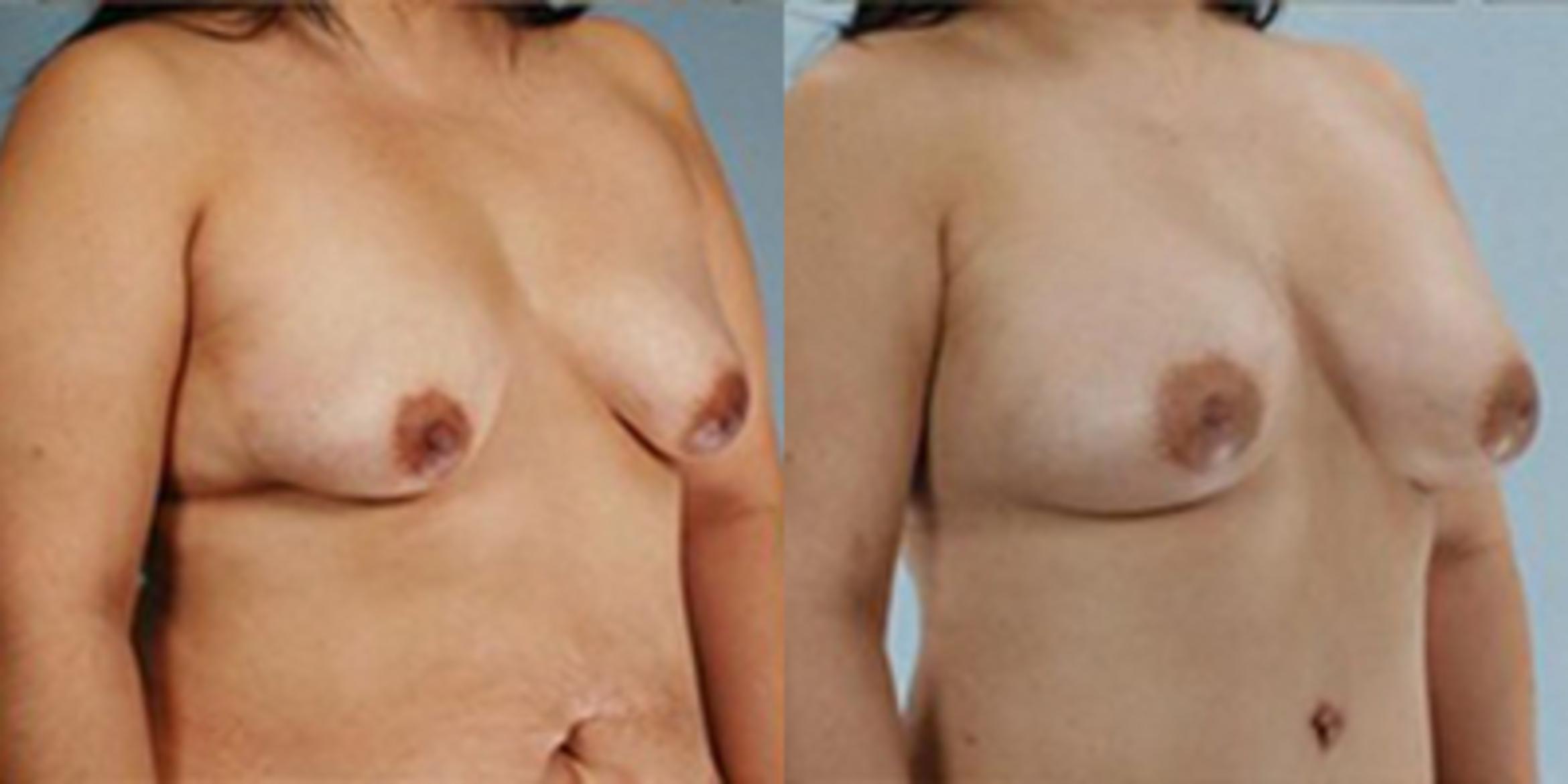 Before & After Breast Augmentation Case 4846 View 2 View in Houston, TX