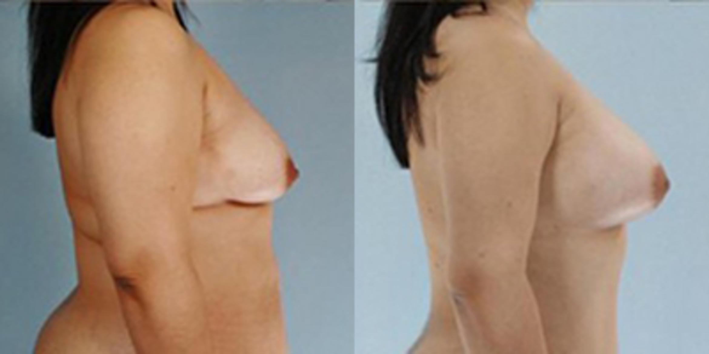 Before & After Breast Augmentation Case 4846 View 3 View in Houston, TX