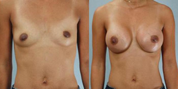 Before & After Breast Augmentation Case 4854 View 1 View in Houston, TX