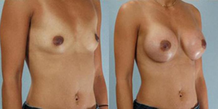 Before & After Breast Augmentation Case 4854 View 2 View in Houston, TX