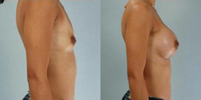 Before & After Breast Augmentation Case 4854 View 3 View in Houston, TX