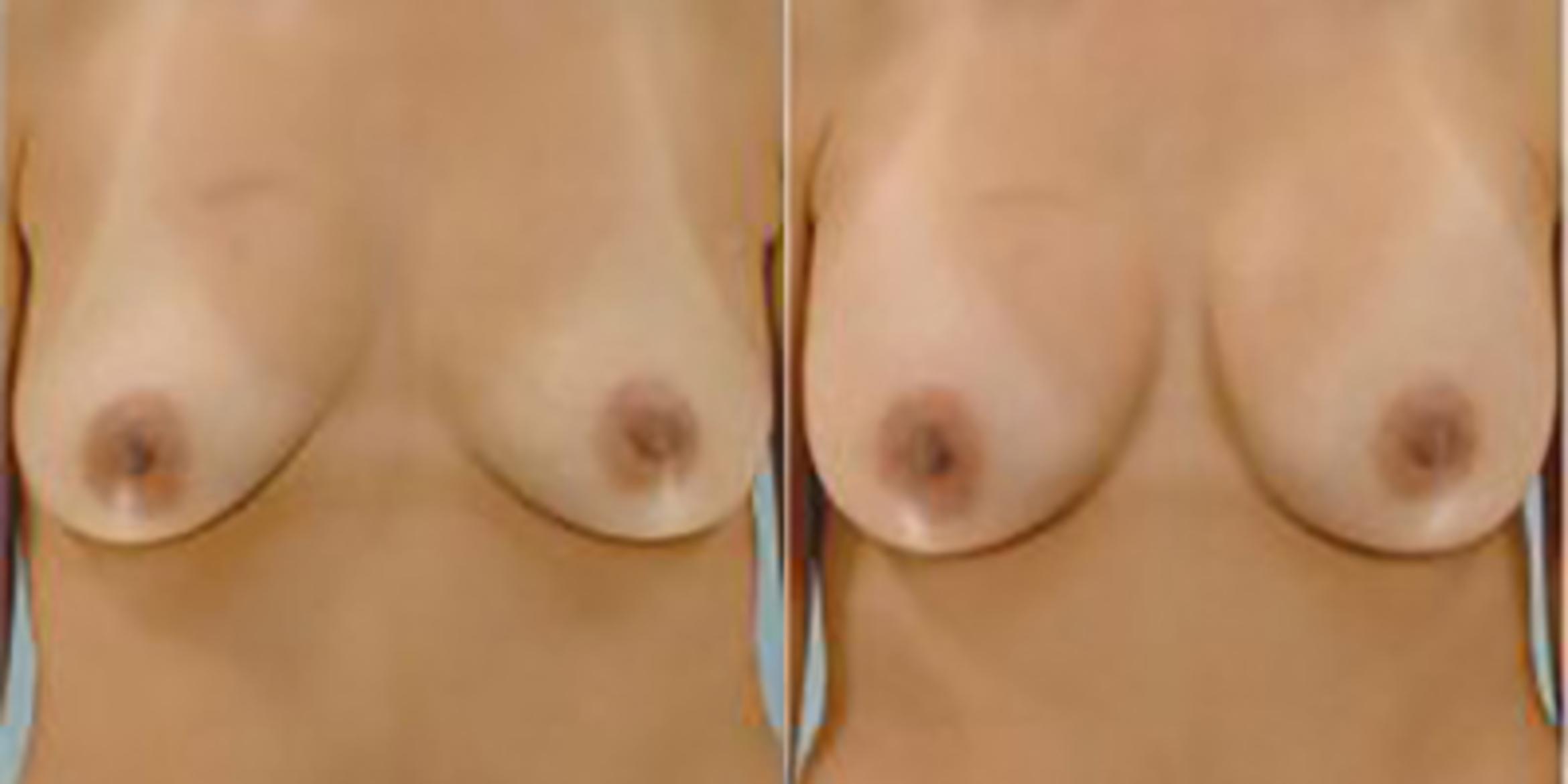 Before & After Breast Augmentation Case 4862 View 1 View in Houston, TX