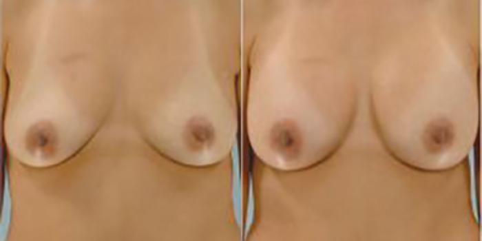Before & After Breast Augmentation Case 4862 View 1 View in Houston, TX