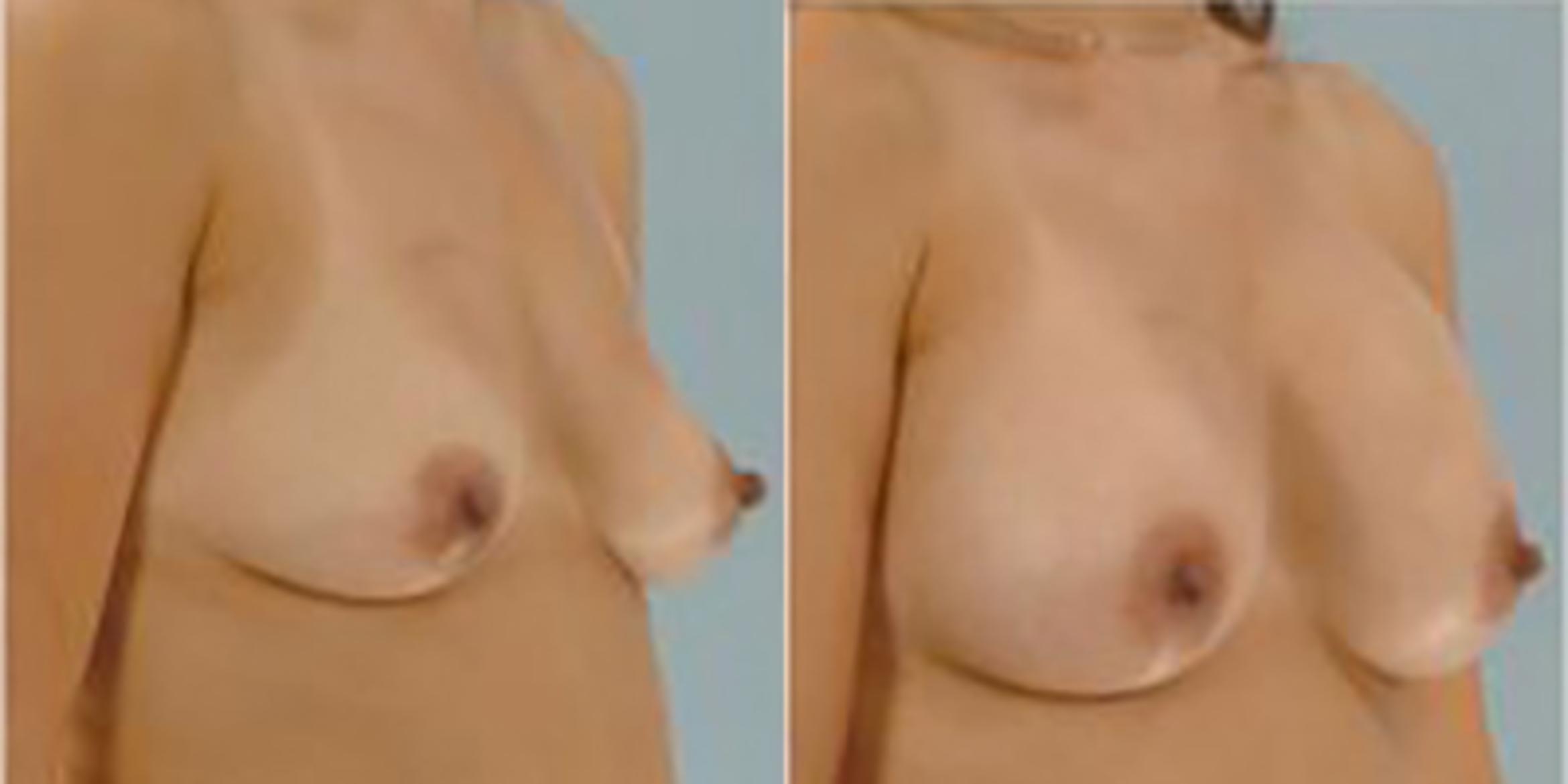 Before & After Breast Augmentation Case 4862 View 2 View in Houston, TX