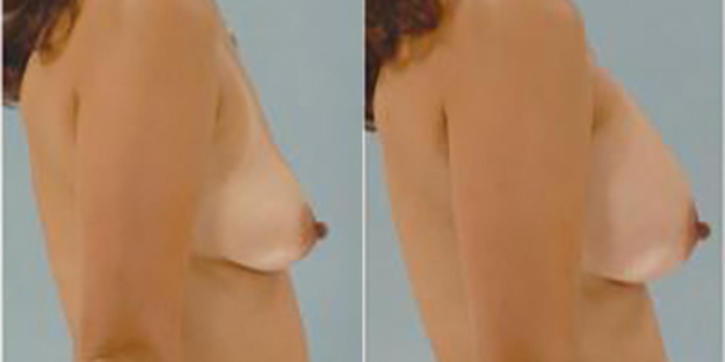 Before & After Breast Augmentation Case 4862 View 3 View in Houston, TX