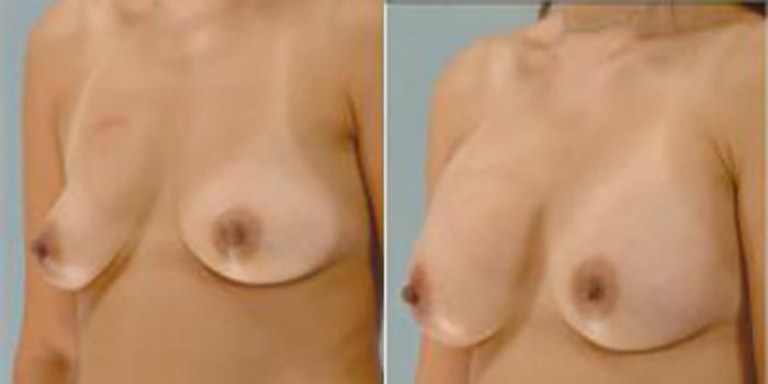 Before & After Breast Augmentation Case 4862 View 4 View in Houston, TX