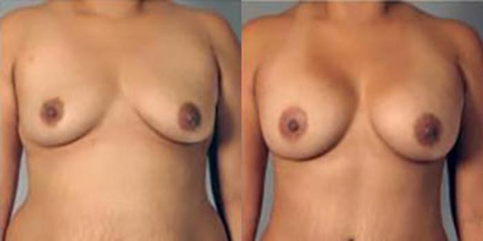 Before & After Breast Augmentation Case 4872 View 1 View in Houston, TX