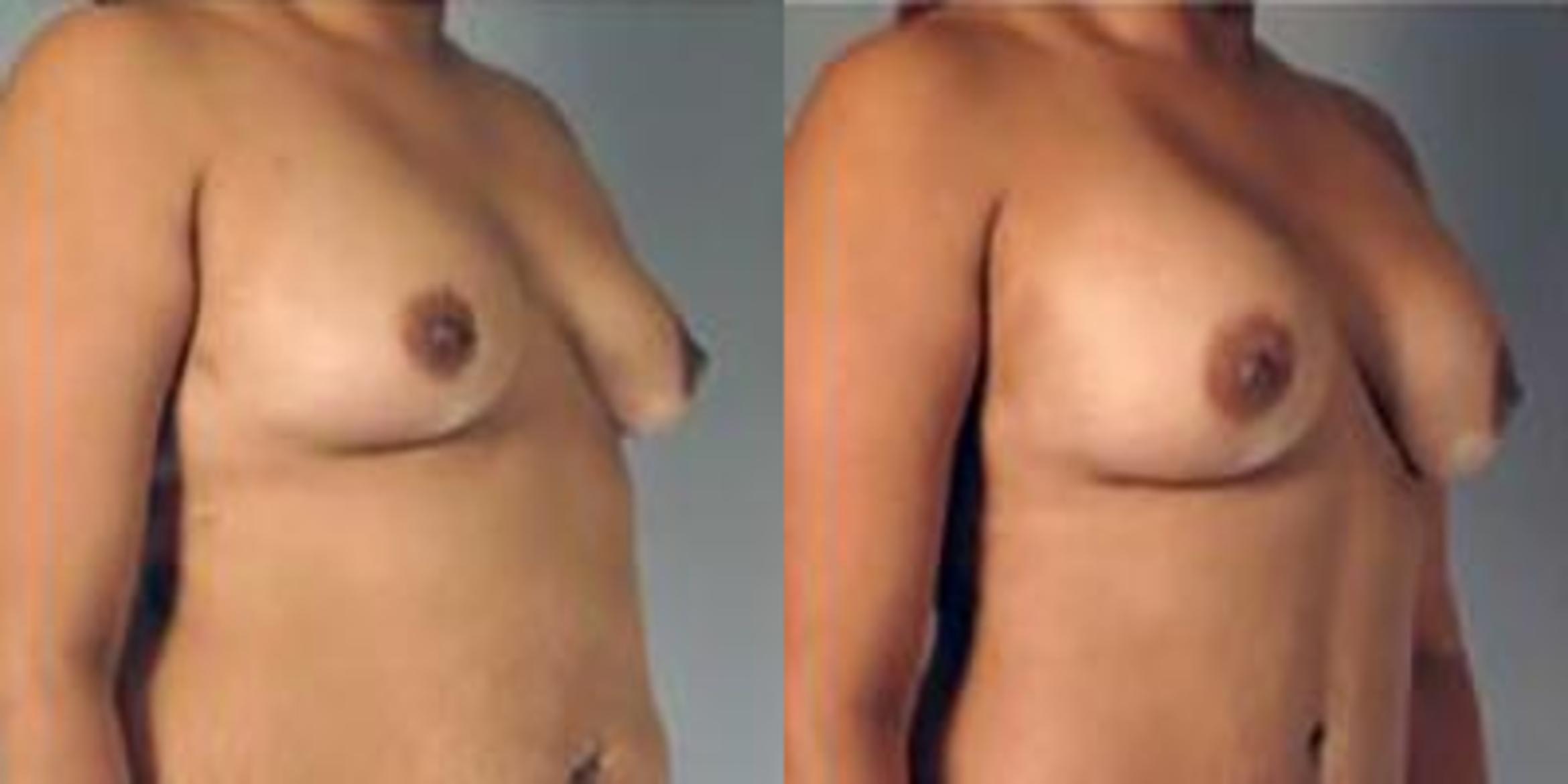 Before & After Breast Augmentation Case 4872 View 2 View in Houston, TX