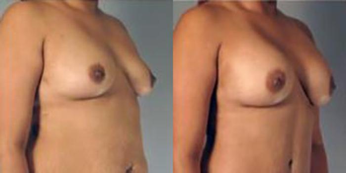 Before & After Breast Augmentation Case 4872 View 2 View in Houston, TX