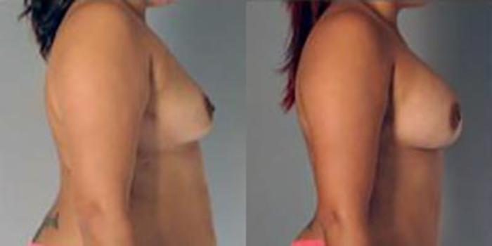 Before & After Breast Augmentation Case 4872 View 3 View in Houston, TX