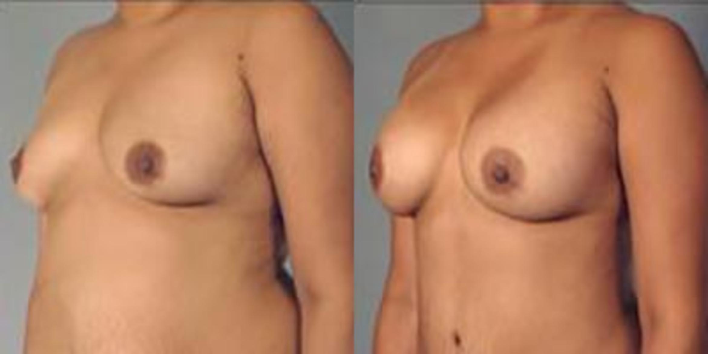 Before & After Breast Augmentation Case 4872 View 4 View in Houston, TX