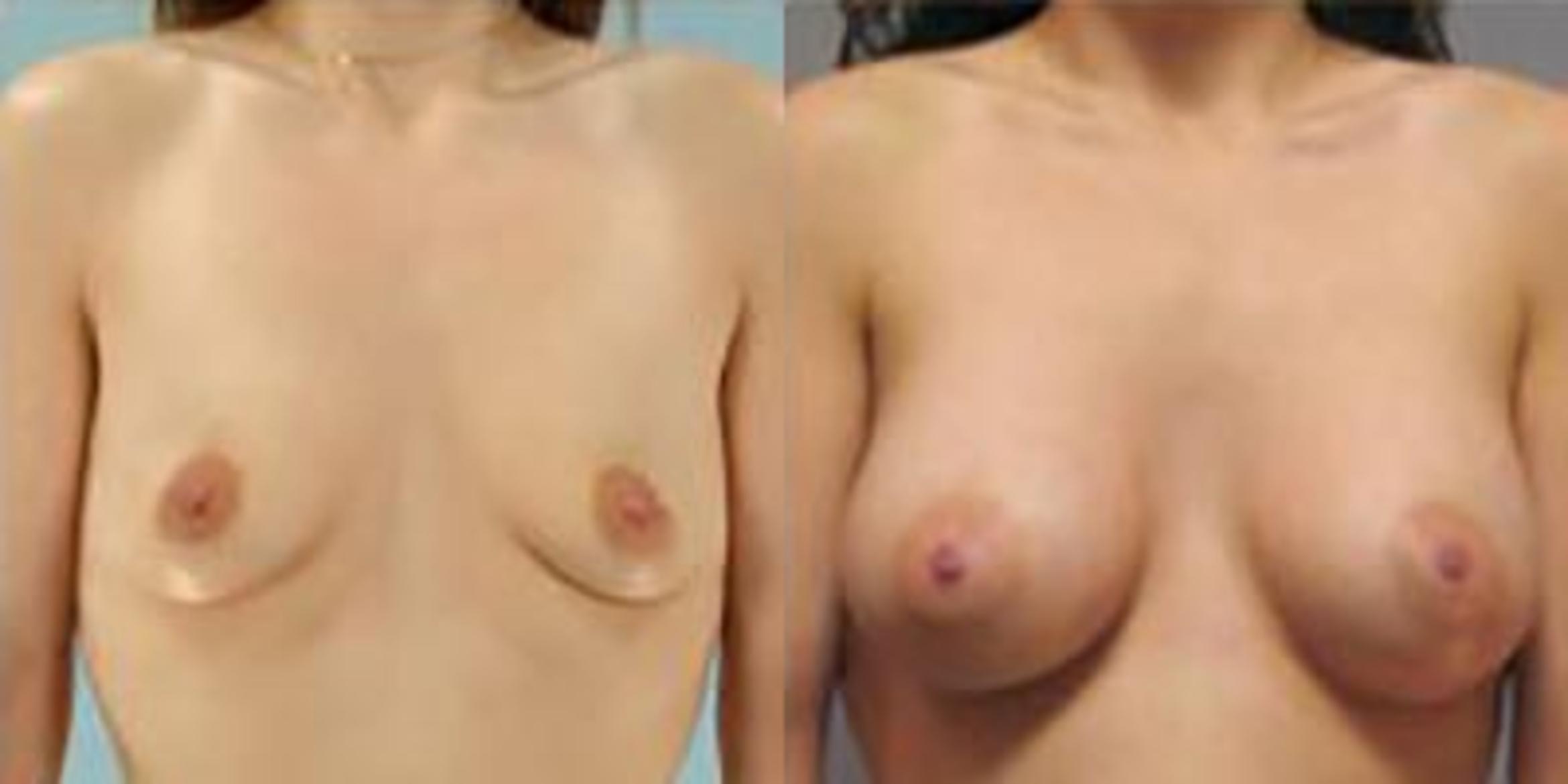 Before & After Breast Augmentation Case 4882 View 1 View in Houston, TX