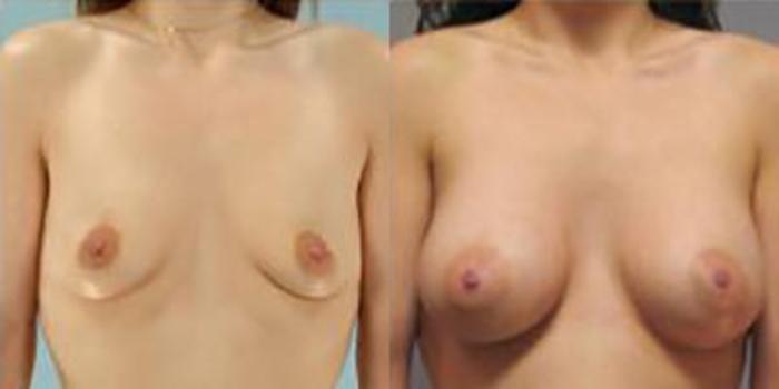 Before & After Breast Augmentation Case 4882 View 1 View in Houston, TX