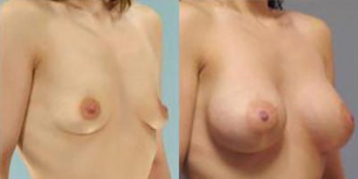 Before & After Breast Augmentation Case 4882 View 2 View in Houston, TX