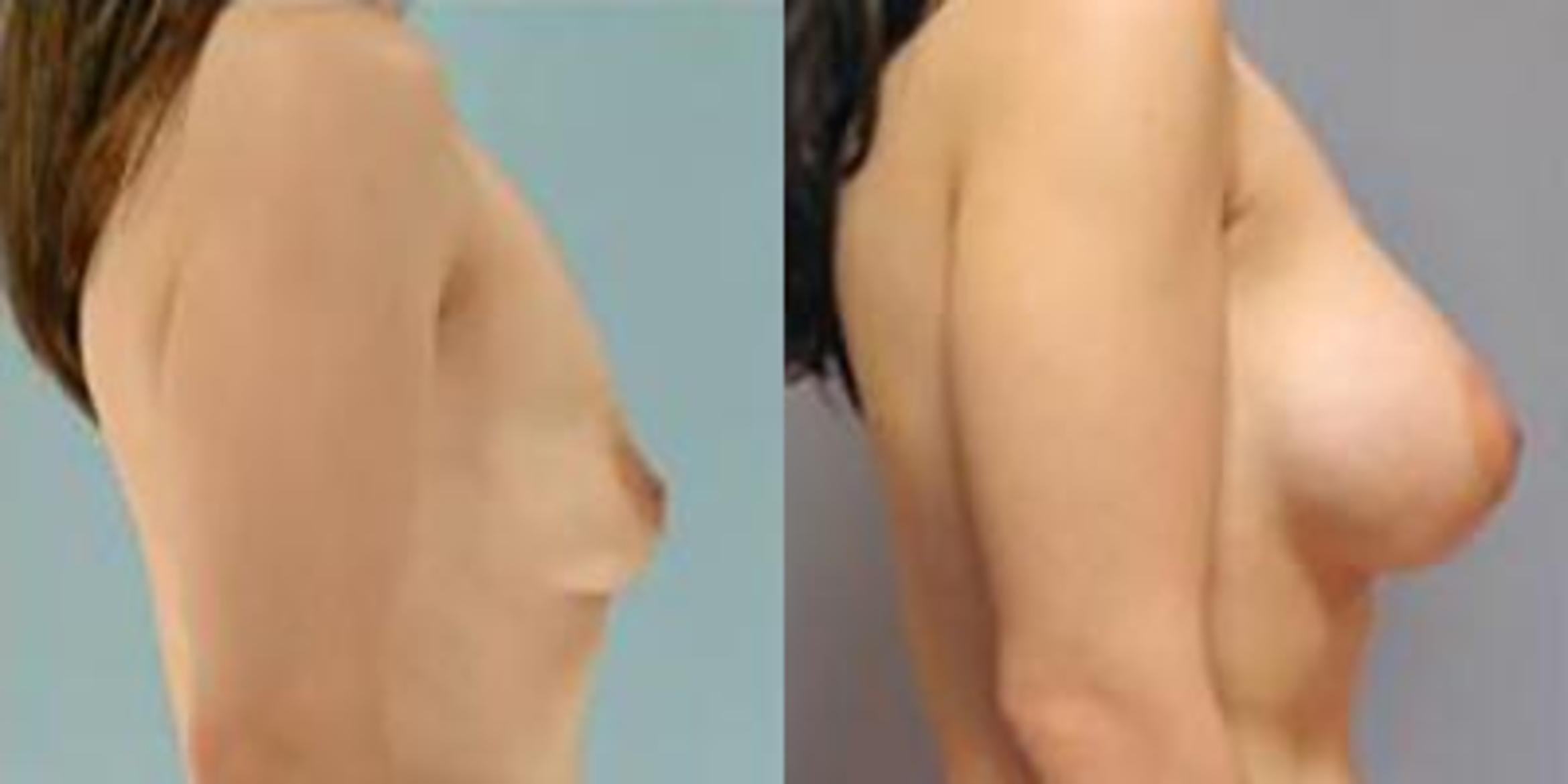 Before & After Breast Augmentation Case 4882 View 3 View in Houston, TX